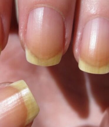 Ongles jaunes ? C’est forcément l’un de ces problèmes de santé effrayants !