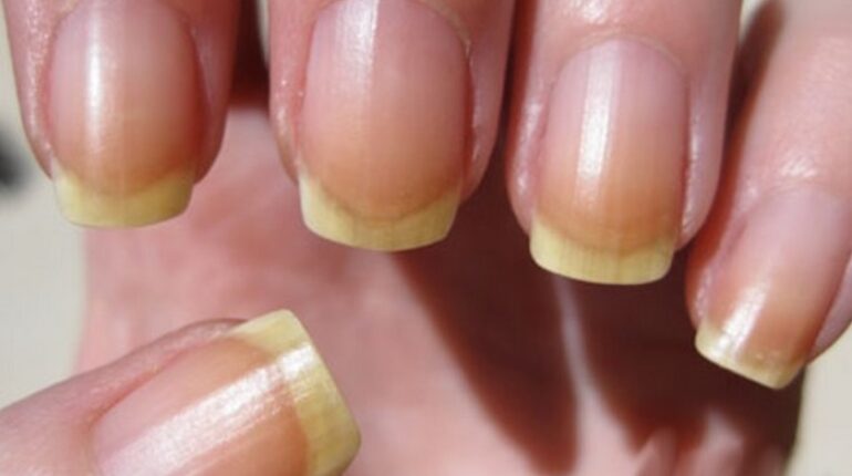 alimentation variee boire de l'eau Confort mains ongles ongles jaunes santé santé France santé nutrition traitement tranquillité vernis a ongles zénitude 