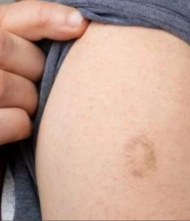 Pourquoi des millions de Français ont une petite cicatrice sur le bras gauche ?