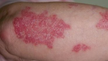 Psoriasis : ces six aliments à bannir