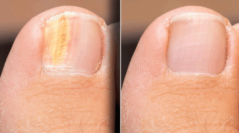 Comment utiliser l’ail pour éliminer les mycoses des ongles ?