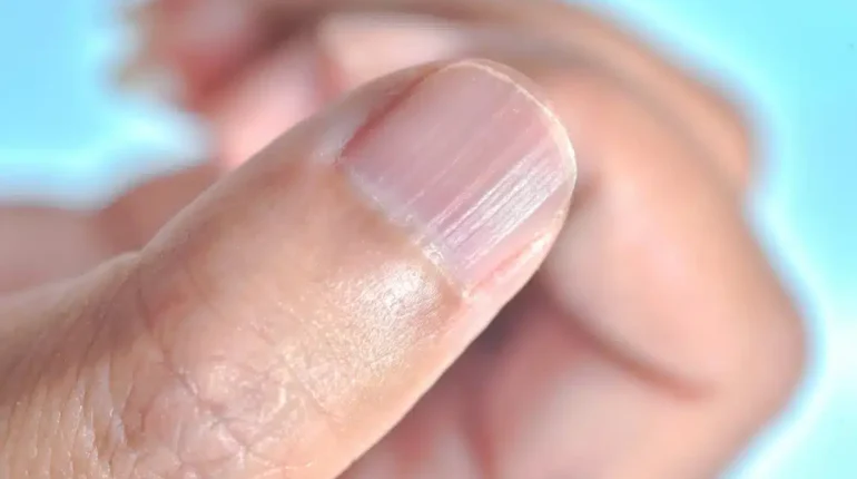 Ce que ces lignes verticales sur vos ongles révèlent réellement