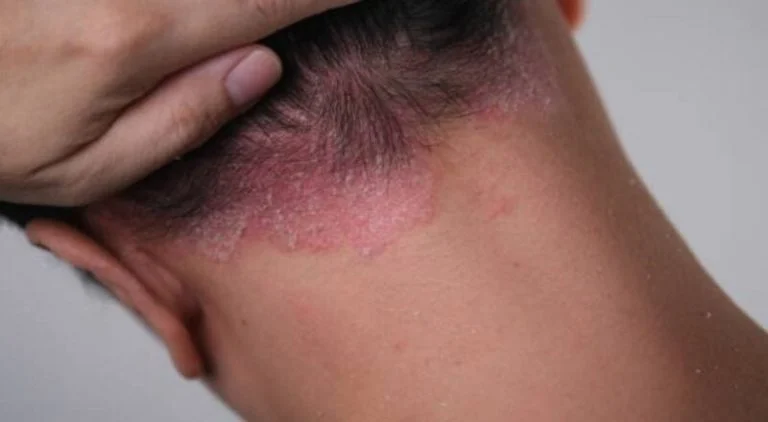 psoriasis-une-maladie-incurable-mais-traitable-qui cover
