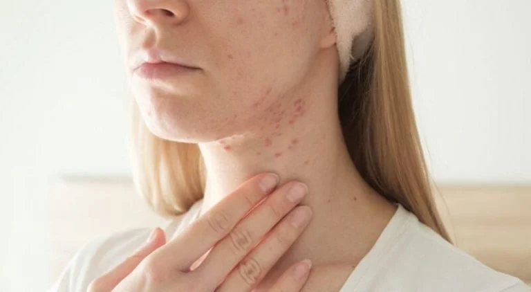 acne-du-cou-les-causes-et-les-soins-recommandes-pa cover